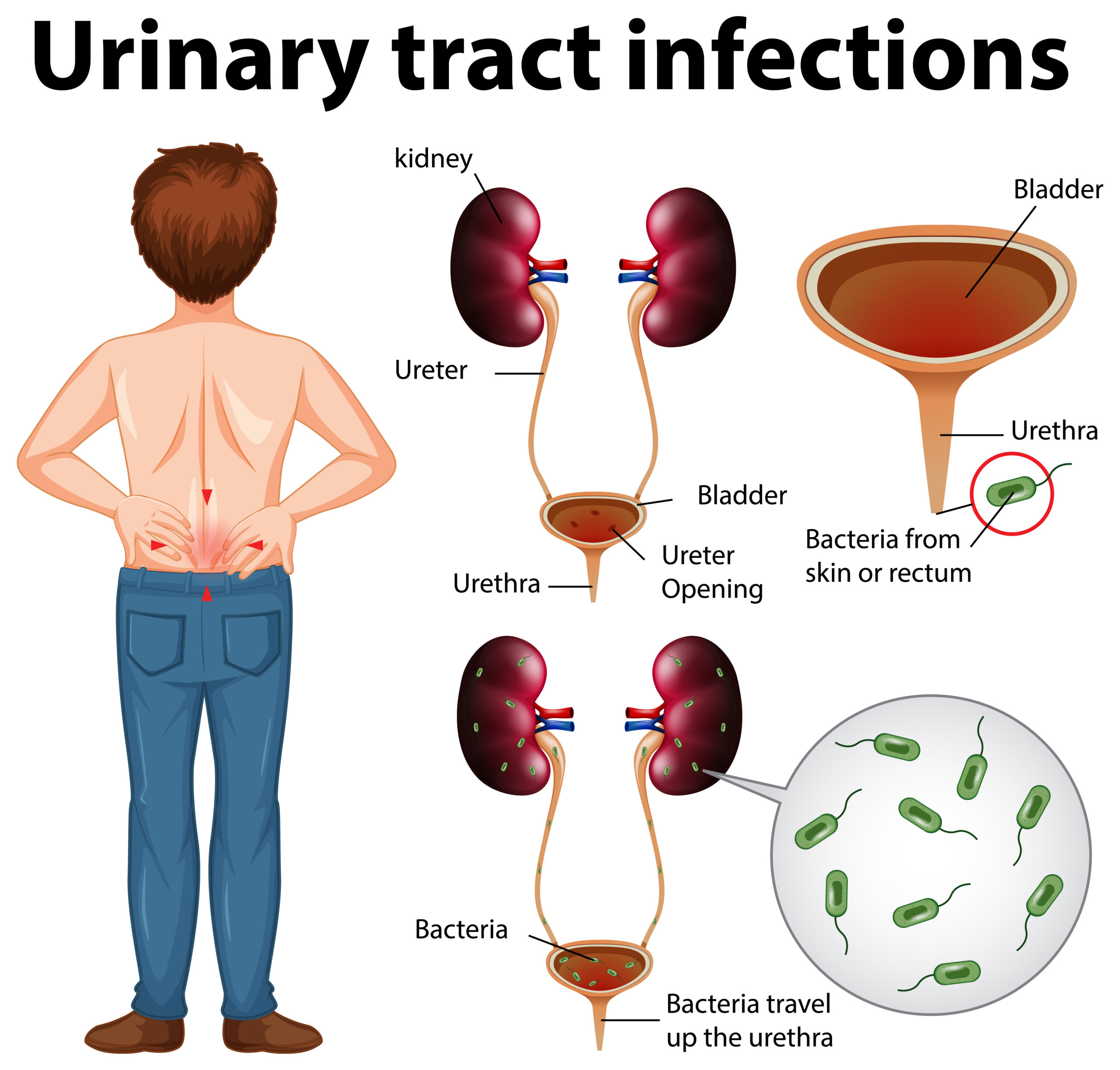 Understanding Urinary Tract Infections (UTIs)